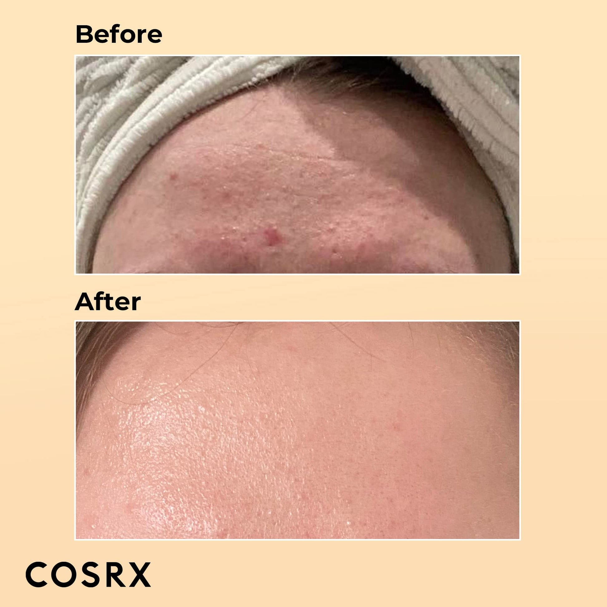 Before and after using COSRX Snail Mucin Essence (96%) - Hydrating Face Serum for Glowing Skin (100ml) - Korean Skincare, Dullness & Fine Lines